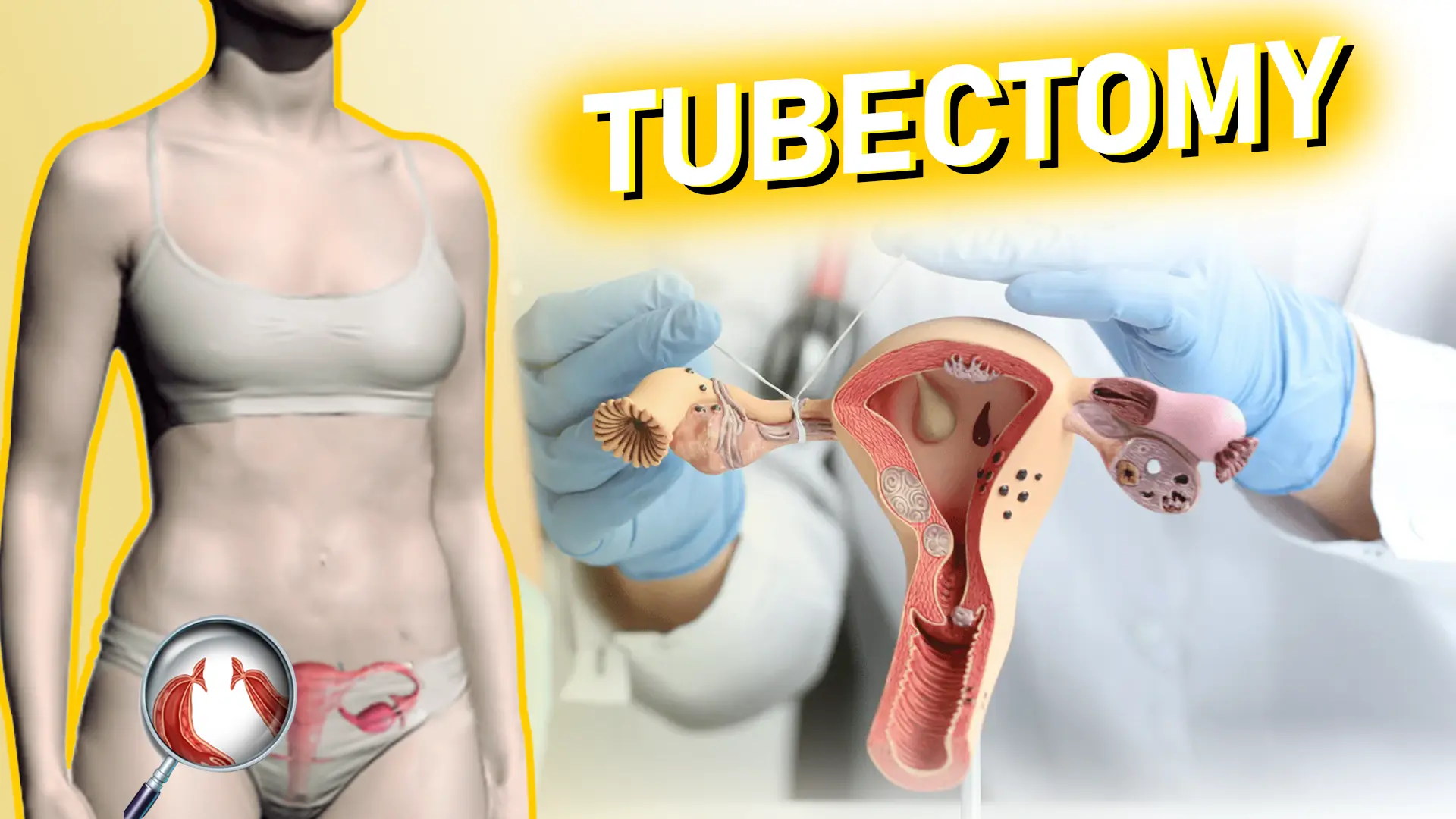 Tubectomy