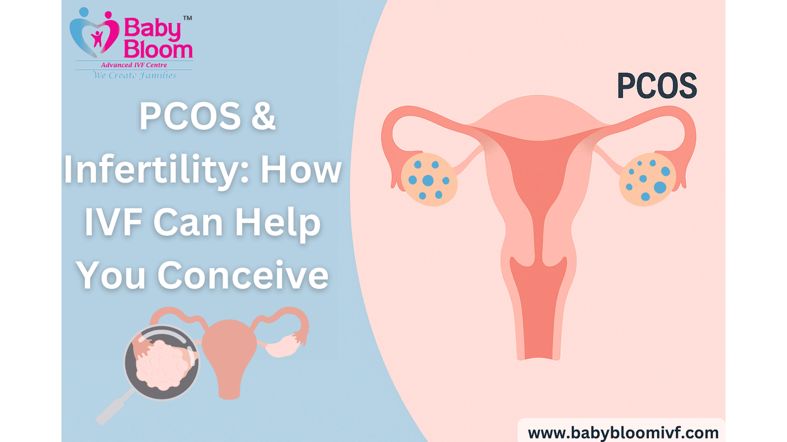 PCOS & Infertility: How IVF Can Help You Conceive