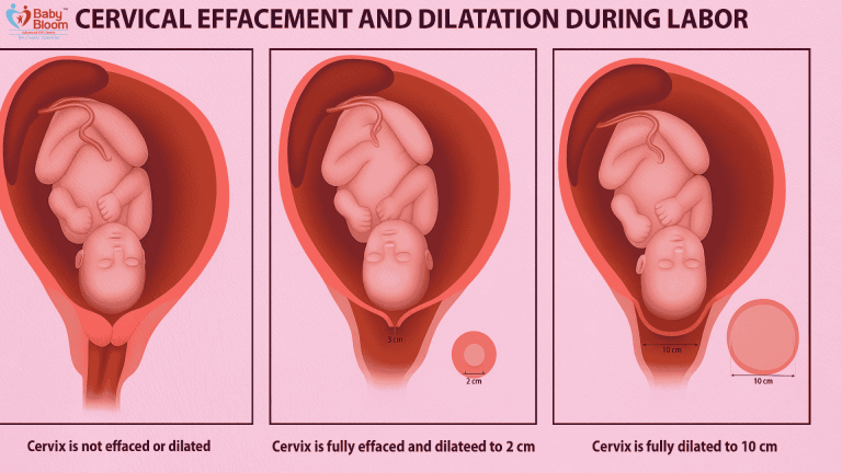 “Cervical Effacement and Dilatation Process in Labor – Visual Guide with 3 Stages | Baby Bloom IVF”