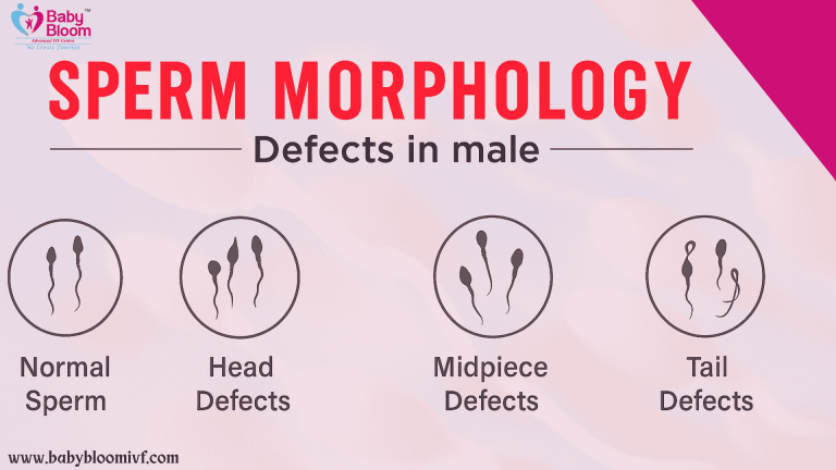 “Sperm Morphology Defects in Males – Normal vs Abnormal Sperm Shapes | Baby Bloom IVF”