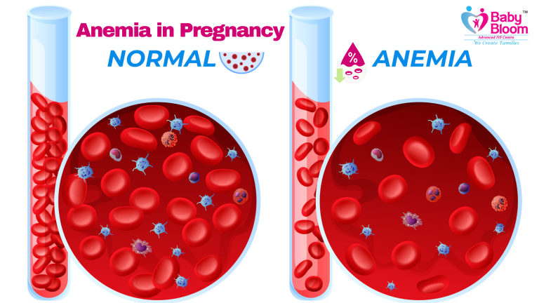 Anemia in Pregnancy – Normal vs Anemia Blood Cells Comparison | Baby Bloom IVF