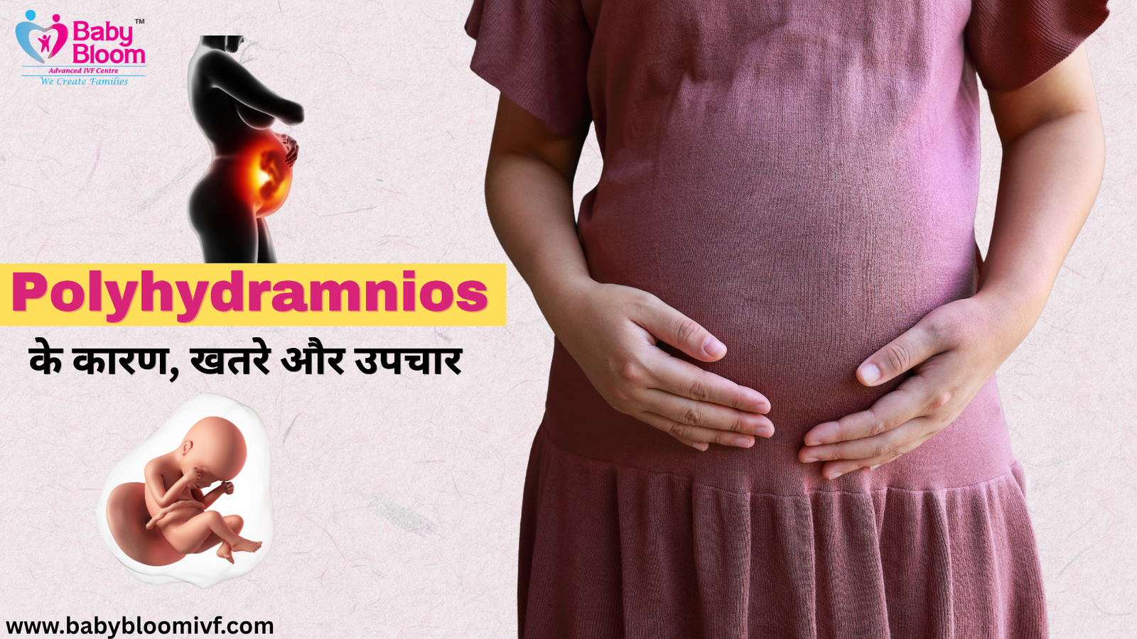 🤰 क्या आपको पता है कि गर्भावस्था में अम्नियोटिक फ्लूइड (Amniotic Fluid) की अधिक मात्रा होना Polyhydramnios कहलाता है?

यह स्थिति कुछ महिलाओं में पाई जाती है और यह कभी-कभी Baby या Mother दोनों के लिए जटिलताएँ पैदा कर सकती है।

🔹 Polyhydramnios के मुख्य कारण:

डायबिटीज़ (Gestational Diabetes)

Twin Pregnancy

Baby के swallowing या growth में समस्या

प्लेसेंटा से जुड़ी जटिलताएँ

🔹 संभावित खतरे:

प्रीमेच्योर डिलीवरी

अधिक ब्लीडिंग (Postpartum Hemorrhage)

बच्चे की गलत पोज़िशन (Breech)

समय से पहले झिल्ली फटना

👩‍⚕️ उपचार:

नियमित अल्ट्रासाउंड और फ्लूइड लेवल की जांच

डॉक्टर की निगरानी में दवा या एम्नियोरिडक्शन

कंट्रोल्ड ब्लड शुगर लेवल

💗 Baby Bloom IVF Centre में विशेषज्ञ डॉक्टर गर्भावस्था की हर जटिलता में आपकी मदद करते हैं, ताकि आप और आपका बच्चा रहें सुरक्षित।

🌐 Visit: www.babybloomivf.com

#Polyhydramnios #PregnancyCare #BabyBloomIVF #AmnioticFluid #MotherCare #PregnancyTips